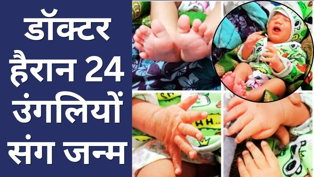 बैतूल में दुर्लभ मेडिकल केस: 24 उंगलियों के साथ जन्मी नवजात बच्ची
