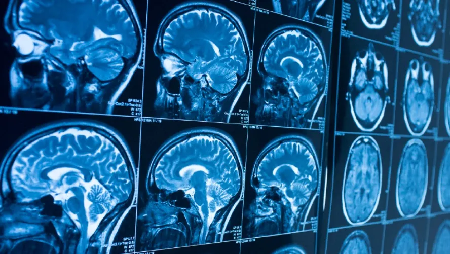 लड़कियां तनाव से, लड़के जोखिम से खिंचते नशे की ओर, ब्रेन स्कैन से खुला सच